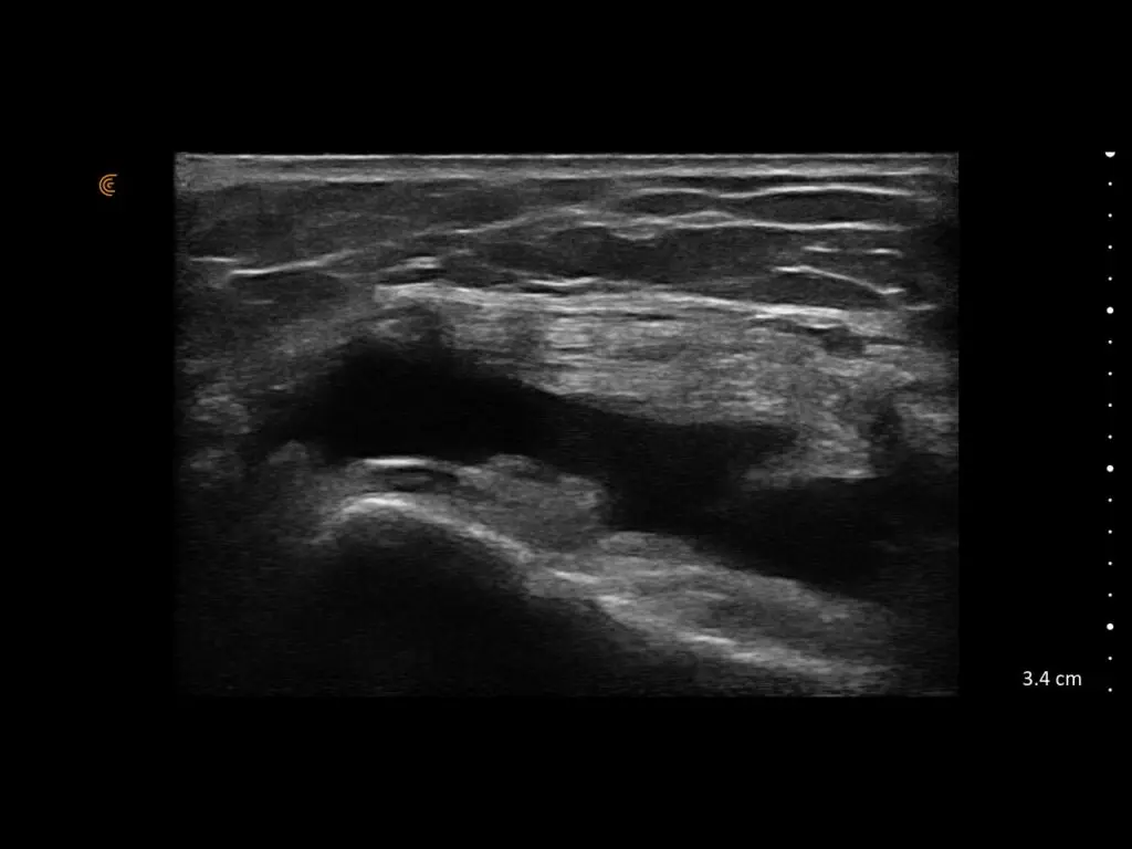 MSK_Ortho_Pain_Suprapatellar-Effusion-Trans_L15_HD3_Tablet.jpeg-1024x768