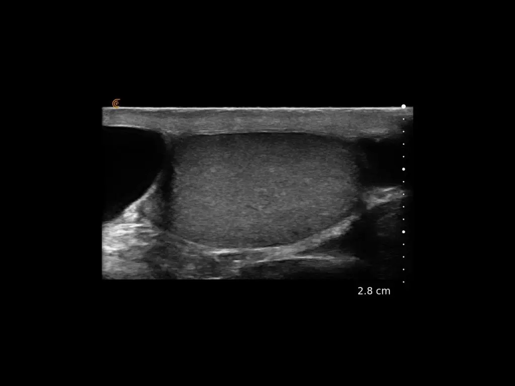 Testicle-with-cyst-1024x768